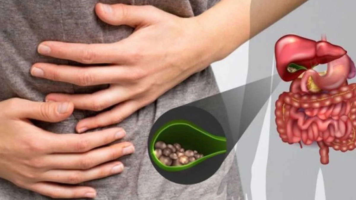 8 Kelompok Orang Dengan Kondisi Tertentu Yang Tidak Boleh Konsumsi Kunyit! 3 Berbagai Macam Pengobatan Batu Empedu