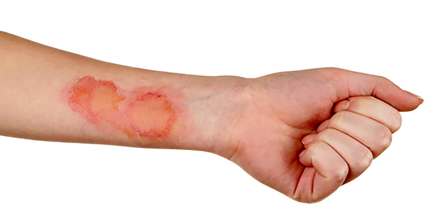 6 Manfaat Es Batu Untuk Kesehatan 3 luka bakar tidak boleh dikompres es