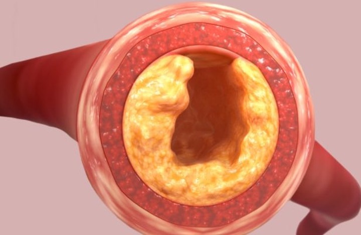 Sedot Lemak dengan Segala Resikonya 5 00226692s6