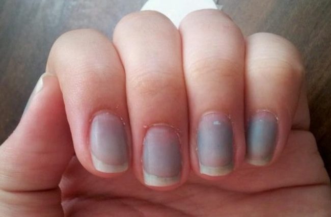 5 Arti Warna Kuku yang Berbeda-beda Dapat Menunjukan Gejala Penyakit Berbahaya 4 What Your Nails Can Tell You About Your Health Bluish Nails 1 e1504763015865