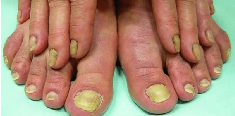 5 Arti Warna Kuku yang Berbeda-beda Dapat Menunjukan Gejala Penyakit Berbahaya 5 fococlipping 20211228 125753