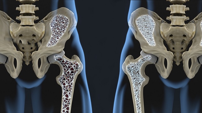 kenali jenis osteoporosis dan cara mencegahnya