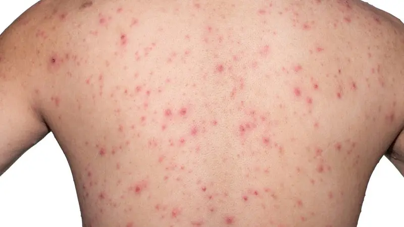 Waspada! Makan Sawo Jika di Konsumsi Berlebihan Dapat Membuat Efek Samping Lho! 4 049699700 1627562463 Tidak Boleh Mandi Saat Cacar Air Mitos atau Fakta