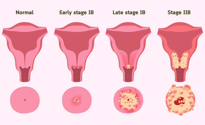 Kanker Serviks: Penyebab dan Penanganan 3 634bc6a880cb1