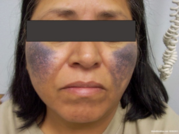 Viral Di Media Sosial, Apa Itu Hidrokuinon dan Bagaimana Sih Dampaknya Terhadap Kulit? Berikut Penjelasannya 4 ochronosis