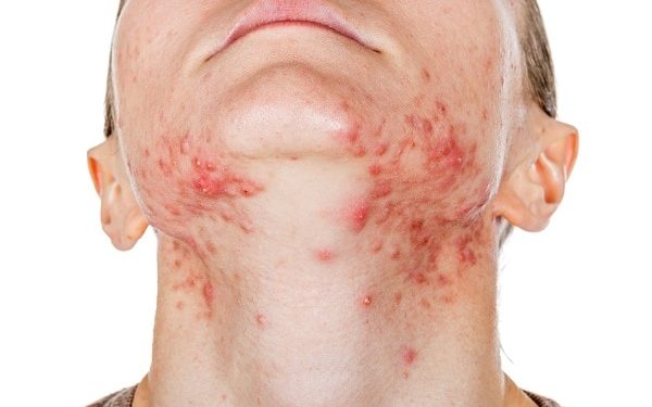 Waspada! Ini Dia 4 Dampak Buruk Makeup Kedaluwarsa bagi Kulit Wajah 4 cara mengatasi alergi pada kulit secara alami 600x375 1