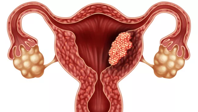 Waspada! 4 Jenis Kanker yang Sering Menyerang Perempuan 5 088692500 1554197921 10 Mitos Kanker Serviks yang Harus Anda Tahu By Lightspring Shutterstock