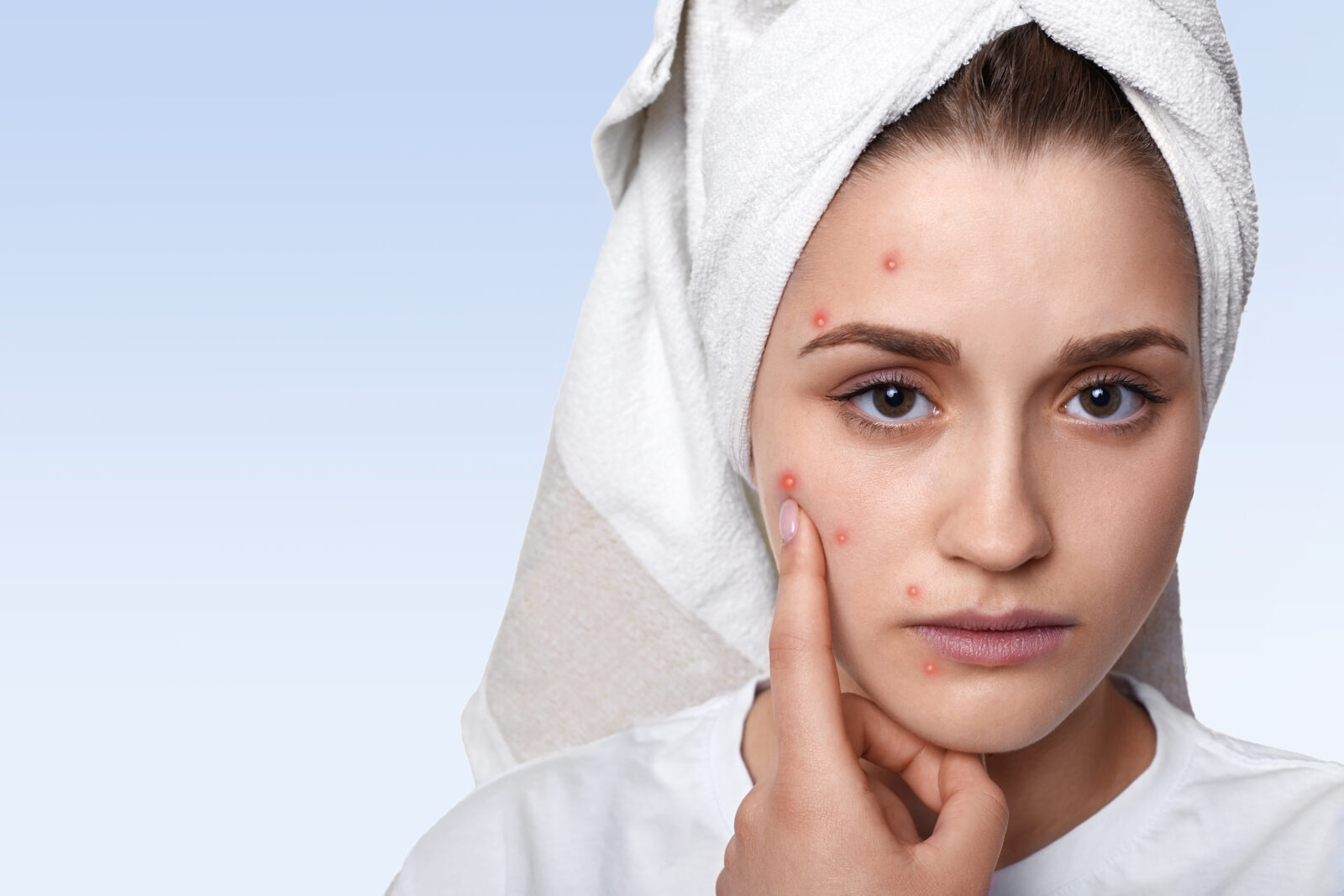 portrait young woman having problem skin pimple her cheek wearing towel her head having sad expression pointing