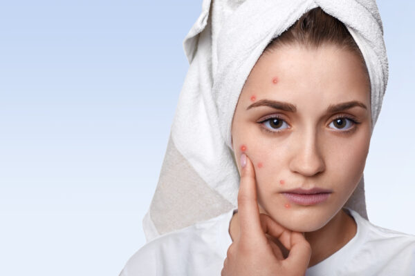 portrait young woman having problem skin pimple her cheek wearing towel her head having sad expression pointing