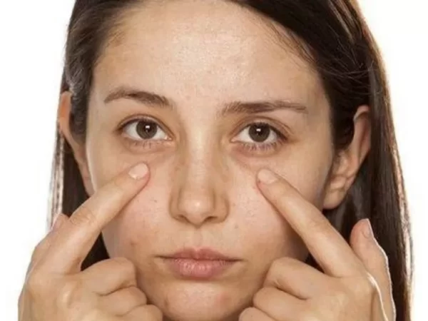 langsung dari dr richard lee begini cara menghilangkan kantung mata32