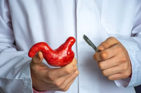 Operasi Bariatrik Manfaat Prosedur dan Risiko.jpg