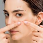 Hati-hati! Ternyata 4 Kebiasaan Ini Menjadi Penyebab Bekas Susah Jerawat Hilang 9 ketahui berbagai cara menghilangkan jerawat dengan cepat