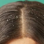 6 jenis ketombe dan penyebab utamanya