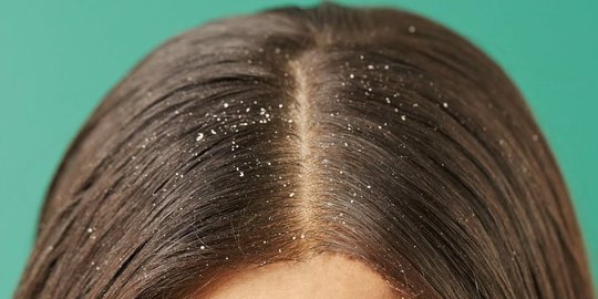 6 jenis ketombe dan penyebab utamanya